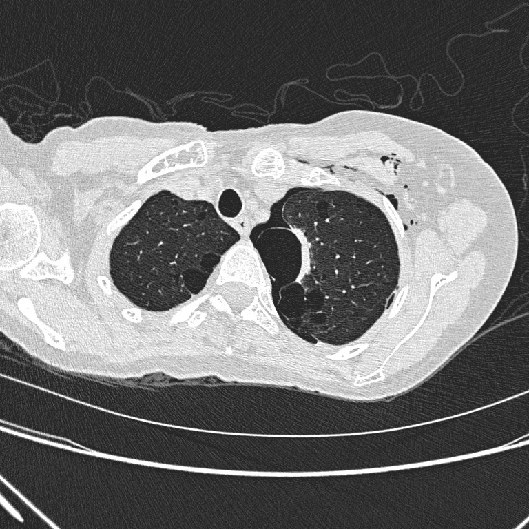 Non-contrast CT thorax